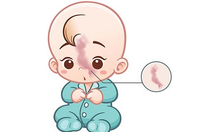 鲜红斑痣患者在治疗方面面临怎样的阻碍？