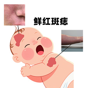 鲜红斑痣可以治好吗？治疗后的效果怎么样？