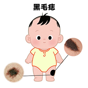 宝宝腿上有块褐色胎记-南京胎记医院排名